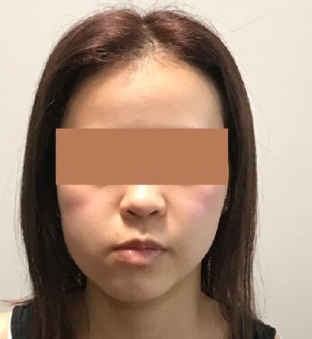顎変形症手術 顔の変化10代　施術後